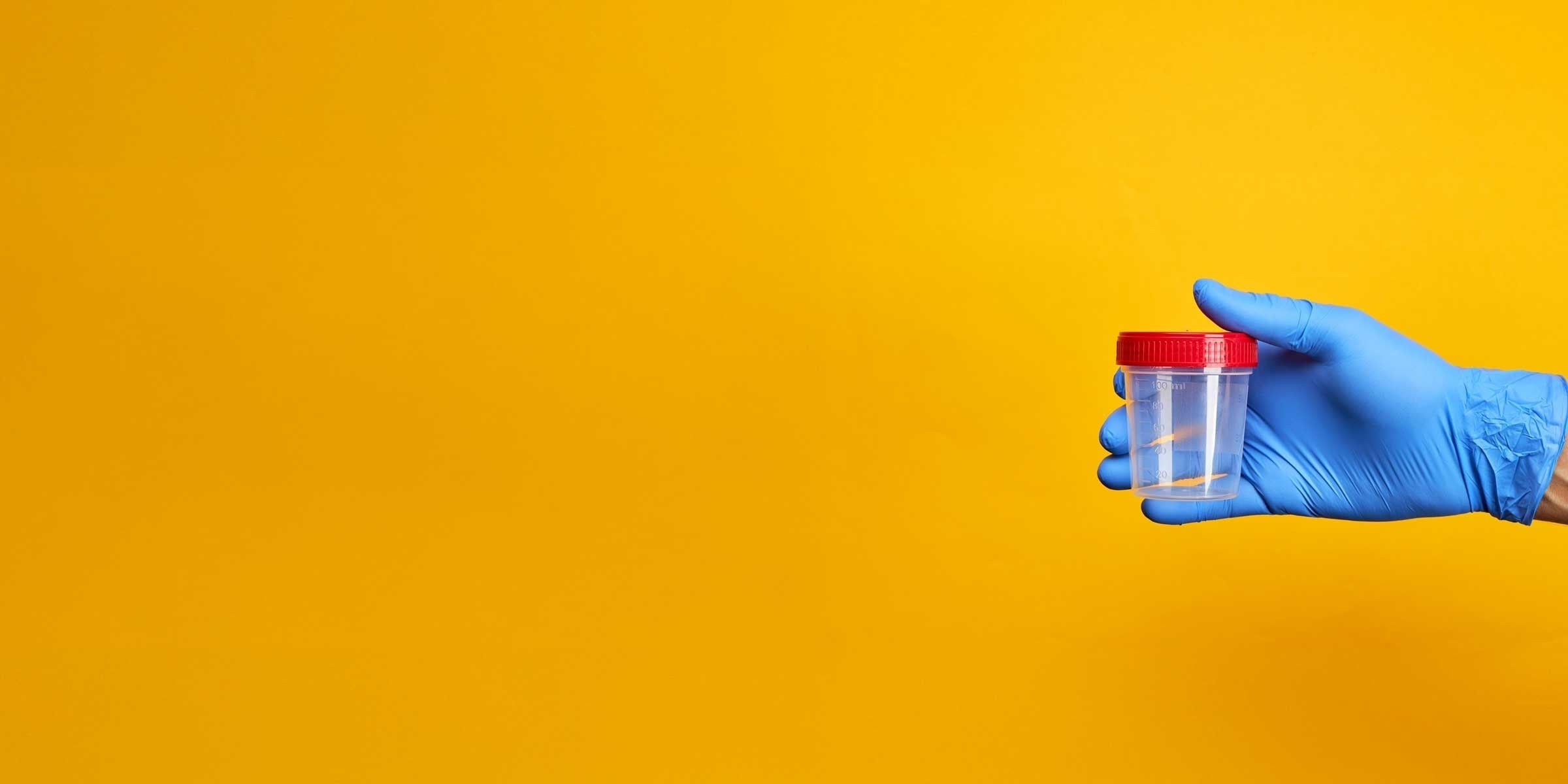 Gloved hand holding cup for uACR test